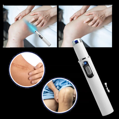 Dark Spot Remover Blue Laser Pen