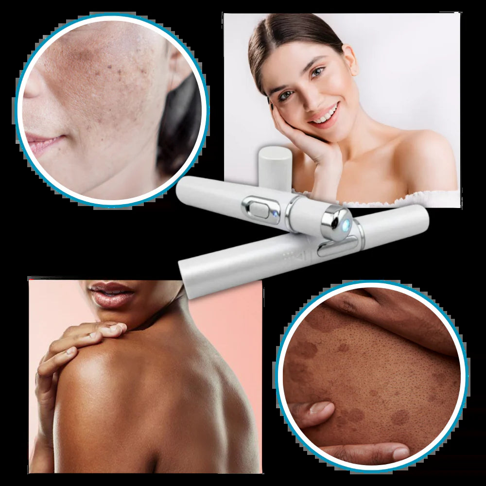 Dark Spot Remover Blue Laser Pen